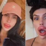 Bizarro: Influencer aplica 20 seringas de preenchimento labial sozinha após clínicas recusarem atendimento por risco à saúde